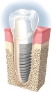 Установка имплантатов зубов