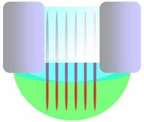 Линии температурной матрицы; фокус энергии распложен в области пересечения лазерной и RF энергий