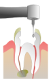 Периодонтит - воспаление корня зуба