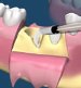 Сохранение структуры десны при удалении зуба