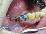 Установленные абатменты на имплантаты в полость рта пациенту