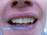 Восстановлена устойчивость подвижных зубов. Восстановлен утраченный зуб.