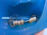 Нанесены бороздки по периметру зубов. Заложена арамидная нить. Зубы укреплены дополнительной конструкцией.