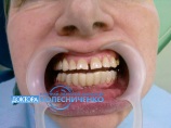 Зубы восстановлены в день обращения.