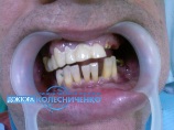 На 44 зубе изготовлена металлокерамическая коронка с дополнительным отверстием для введения арамидной нити.