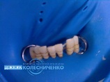 Учитывая высоту коронок и степень подвижности зубов применен метод двухрядного шинирования.