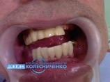 Восстановлена форма зубов. Проведена художественная реставрация зубов с помощью светоотверждающих материалов.