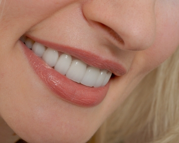 Восстановление зубов с помощью виниров